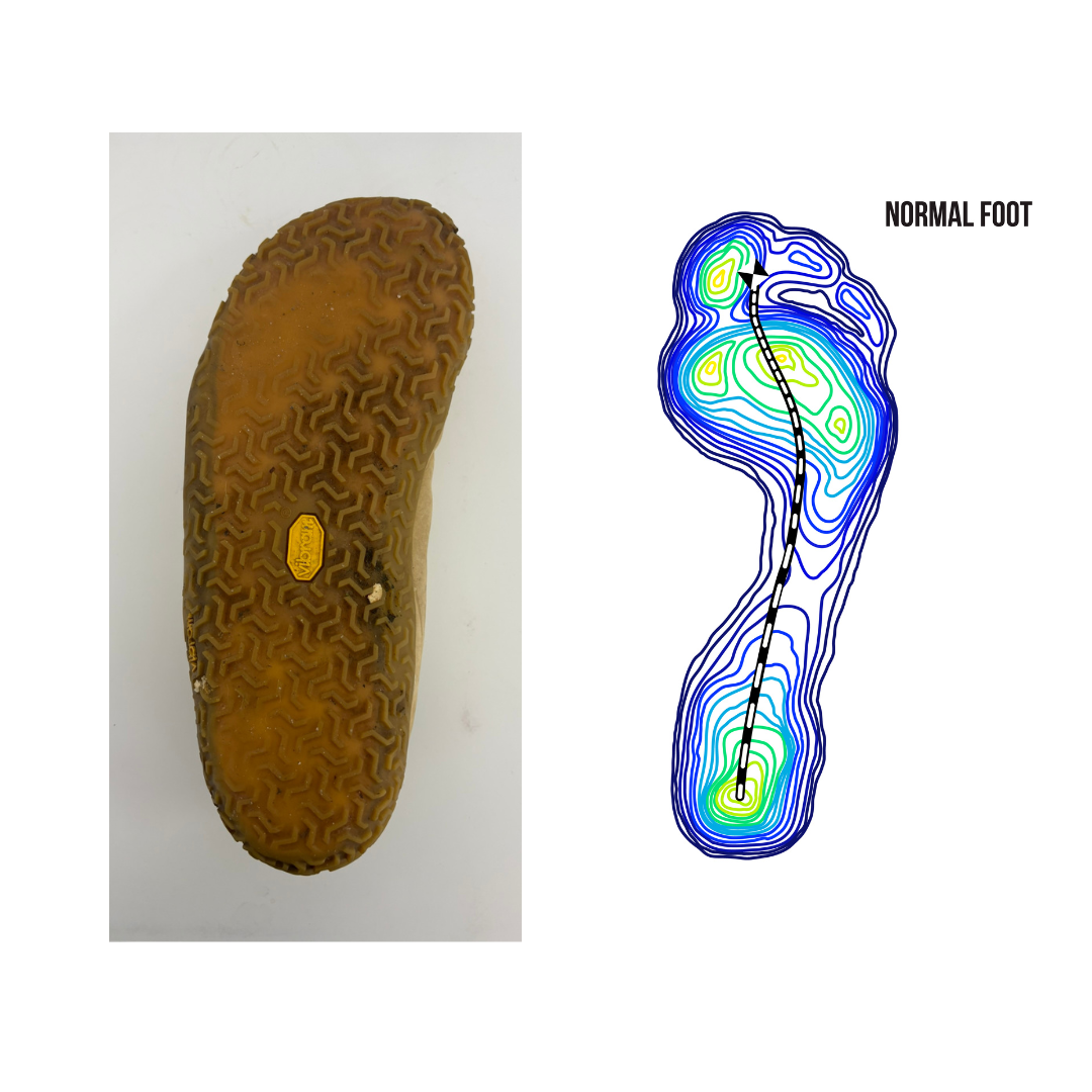 Plantar Fasciitis Pressure